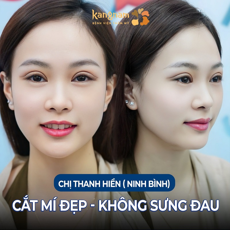 Nếp mí đẹp tự nhiên, hai bên mắt cân đối, không còn sưng đau