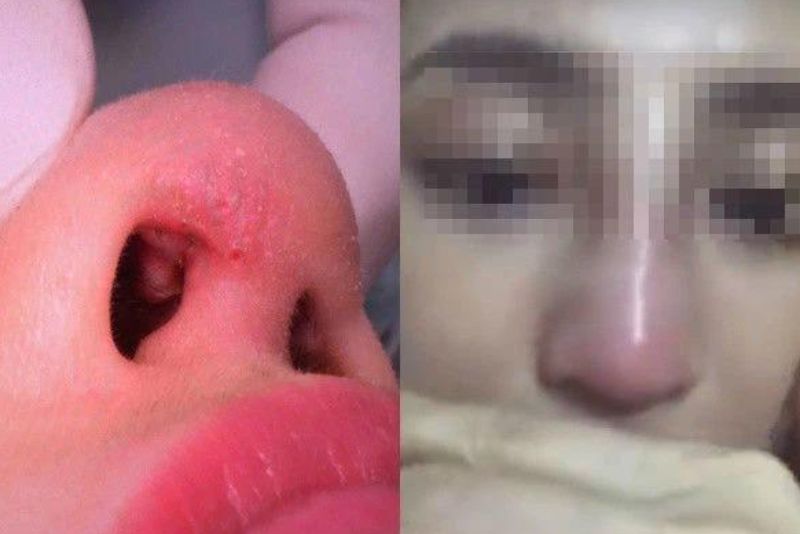 Viêm nhiễm nghiêm trọng ảnh hưởng cấu trúc và thẩm mỹ mũi