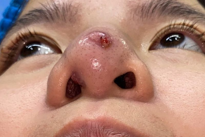 Biến chứng viêm sau nâng mũi nếu không chăm sóc đúng cách