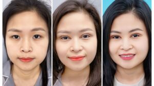 Hình ảnh cắt mí sau 1 tháng? mí mắt đã hồi phục chưa