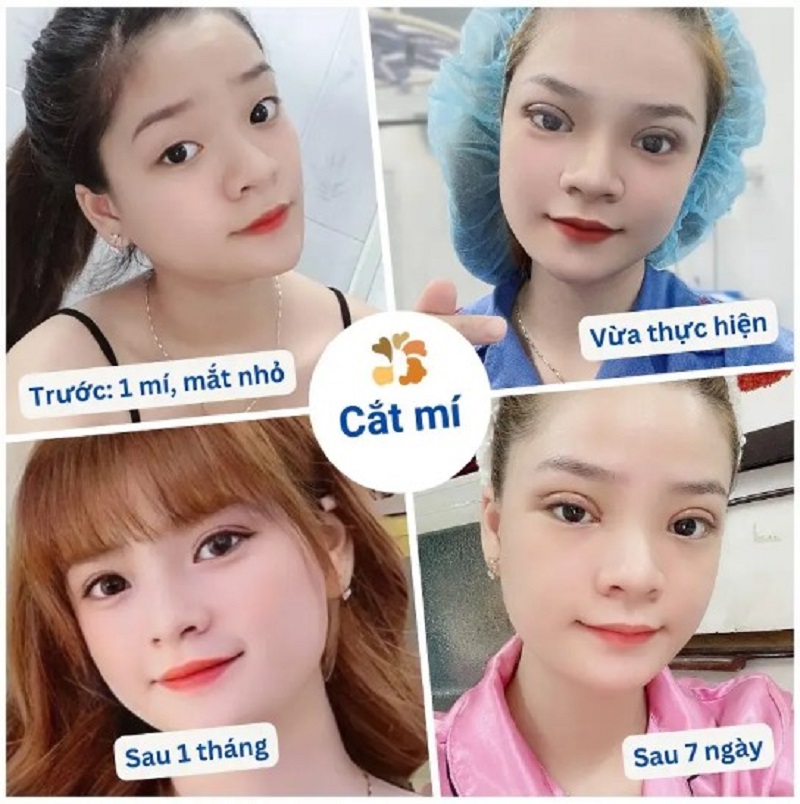 Hình ảnh khách hàng cắt mí tại Kangnam sau 1 tháng