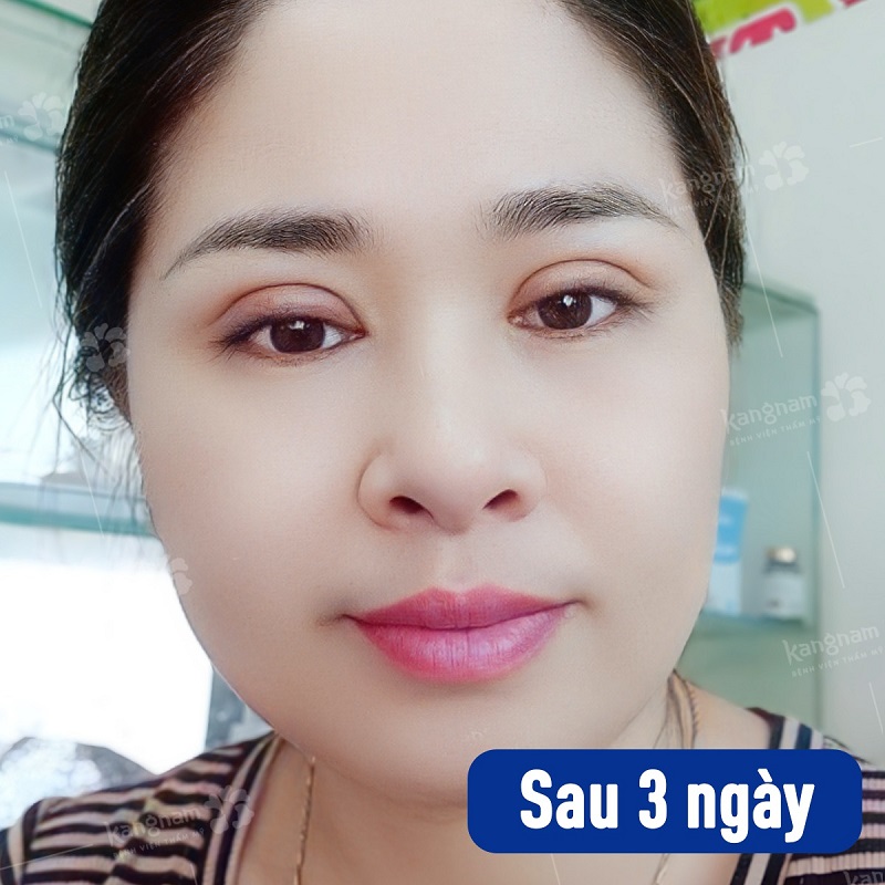 Mí mắt sau 3 ngày vẫn còn hơi sưng