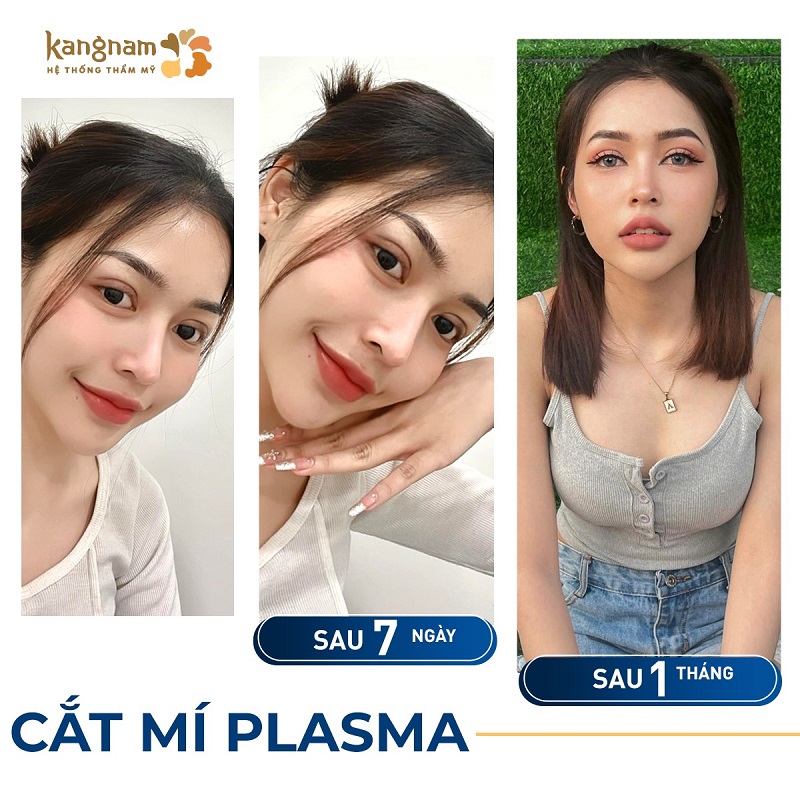 hình ảnh cắt mí sau 1 tháng đã vào form, hết sưng tấy