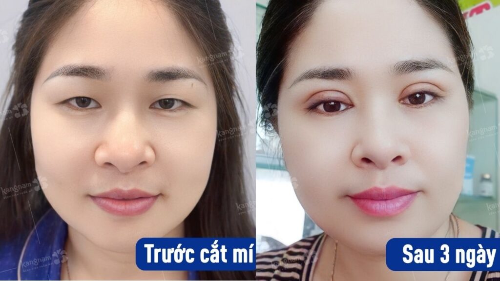 Hình ảnh cắt mí sau 3 ngày, mí mắt đều đẹp tự nhiên