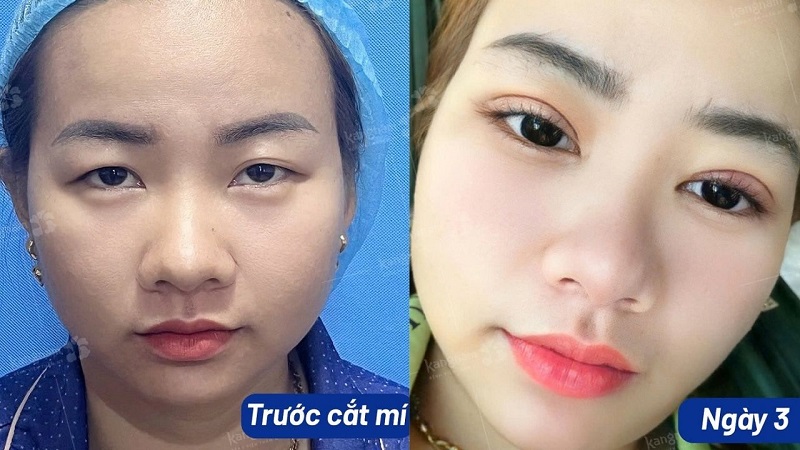 Mí mắt sau cắt 3 ngày đang có triệu chứng sưng tấy