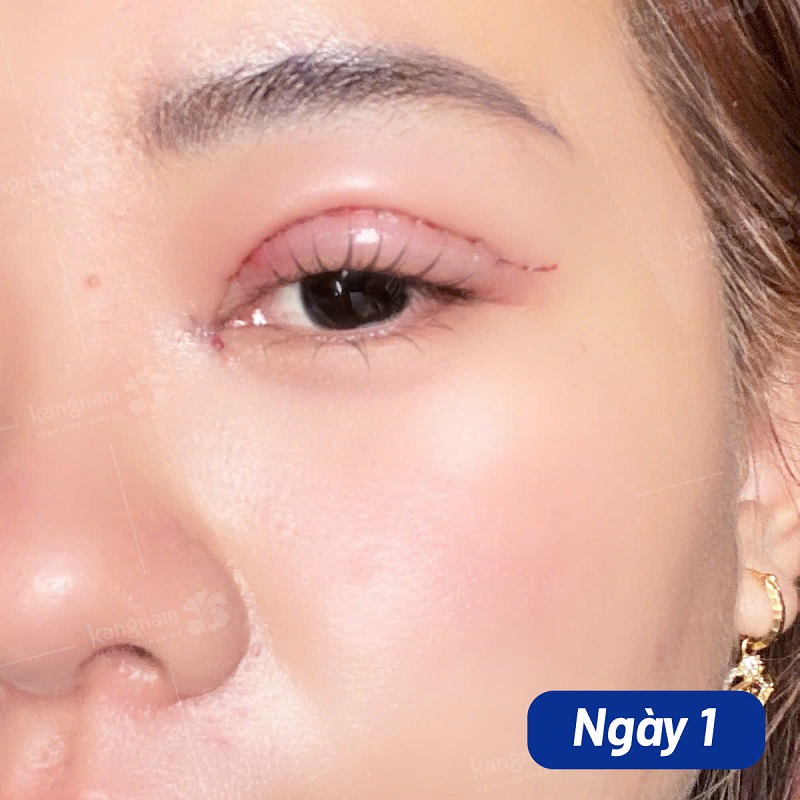 Vừa cắt mí xong khách hàng sẽ gặp tình trạng mí sưng đau