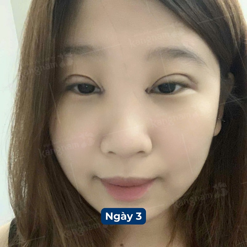 Hình ảnh cắt mí sau 3 ngày vết thương đã khô, nếp mí vẫn còn to chưa vào form