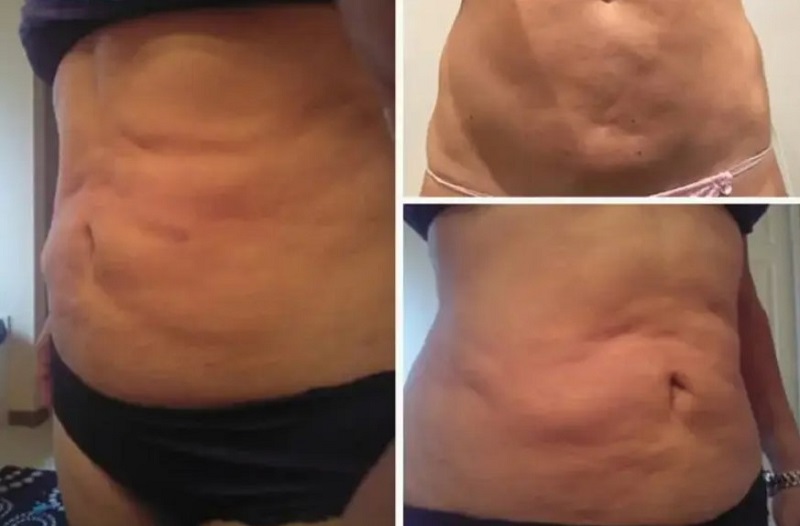 Nếu quan hệ quá sớm có thể khiến vùng bụng lồi lõm, ảnh hưởng đến kết quả