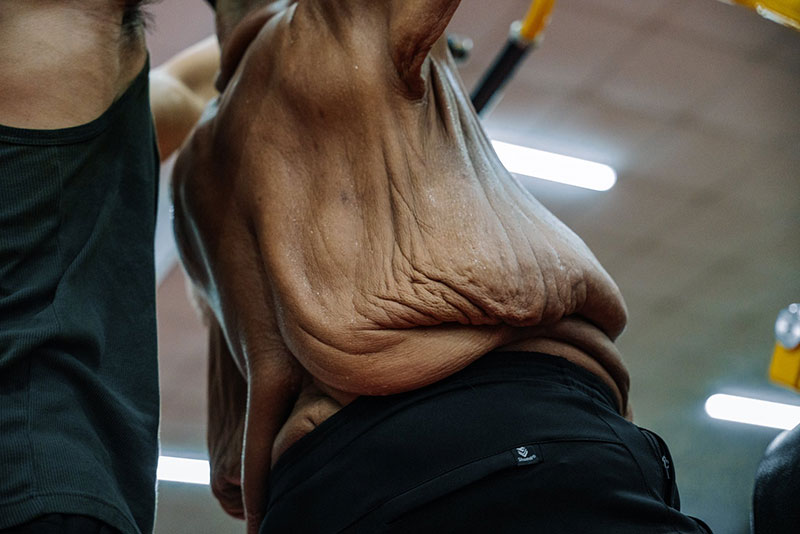 Da chùng nhão cấp độ nặng sau giảm cân