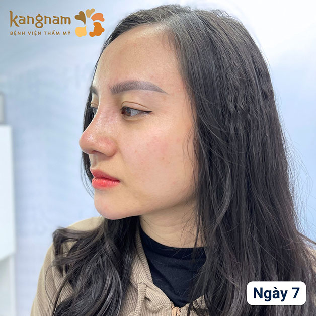 Đầu mũi to sau nâng mũi là phản ứng sưng nề hoàn toàn bình thường