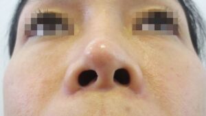 Lộ sụn đầu mũi: Dấu hiệu nhận biết và cách khắc phục an toàn