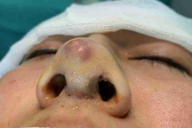 Có nhiều nguyên nhân gây lộ sụn mũi