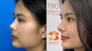 Nâng mũi gom lại có thấp không? Giải thích hiện tượng & cách chăm sóc