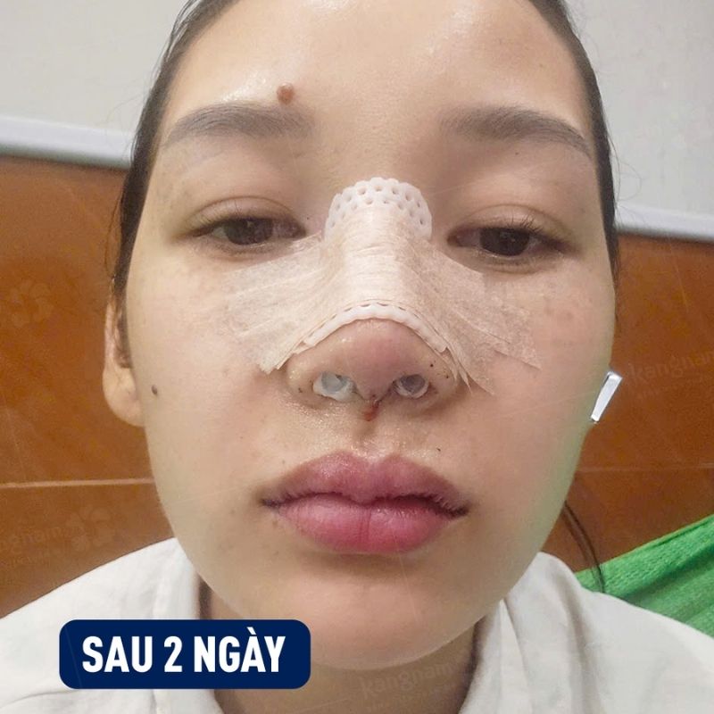 Tránh cúi đầu trong những ngày đầu nâng mũi