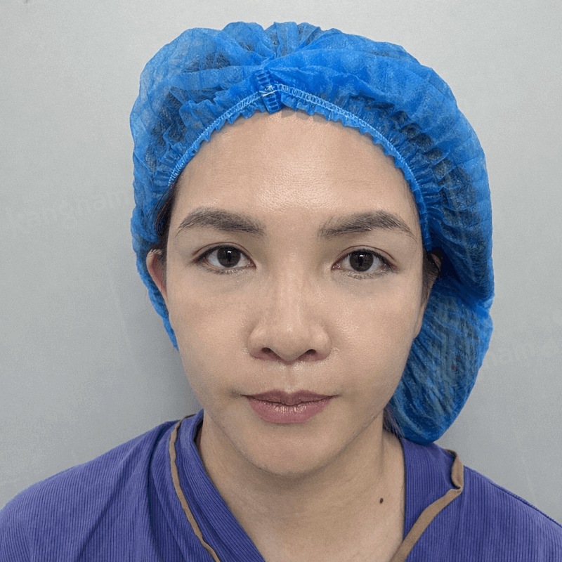 Chị Ngọc Vân gặp tình trạng sụp mí, cung mày chảy xệ