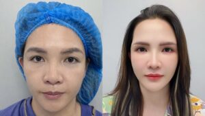 Khách hàng Ngọc Vân cải thiện mí mắt sụp tại Bệnh viện Thẩm mỹ Kangnam Hà Nội