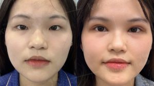 Nhấn mí mắt bao lâu thì lành? Thời gian hồi phục theo từng giai đoạn