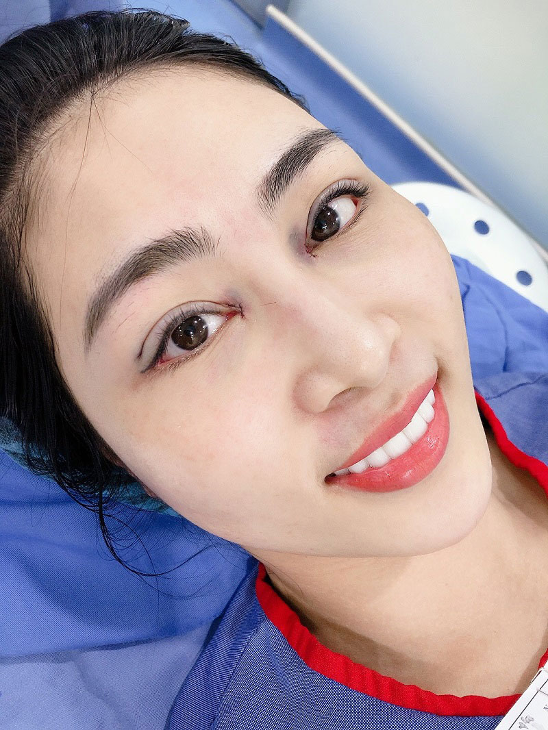 Mí mắt sau khi nhấn sẽ bị sưng tấy, bầm tím