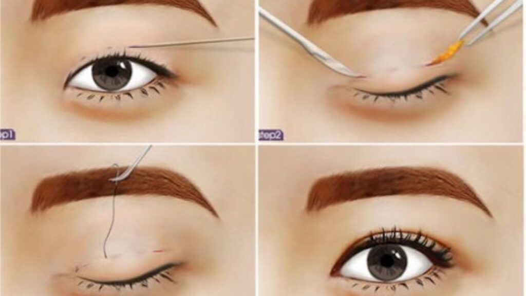 Nhấn mí có cần cắt chỉ không? Giải đáp chi tiết & những điều cần biết