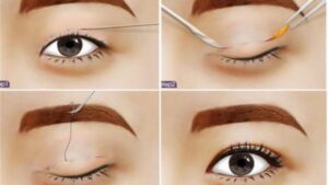 Nhấn mí có cần cắt chỉ không? Giải đáp chi tiết & những điều cần biết