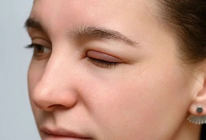 Nếu mí lộ chỉ hoặc lệch chỉ thì cần phải rút chỉ