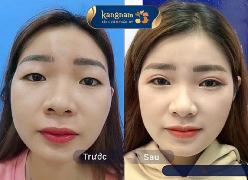 Nếp mí bị mờ có thể nhấn mí lại