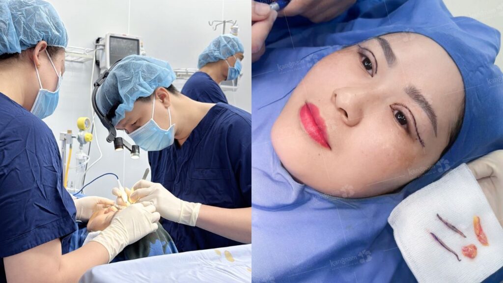 Cắt mí là gì? Hiểu đúng về phương pháp tạo mí mắt phổ biến hiện nay