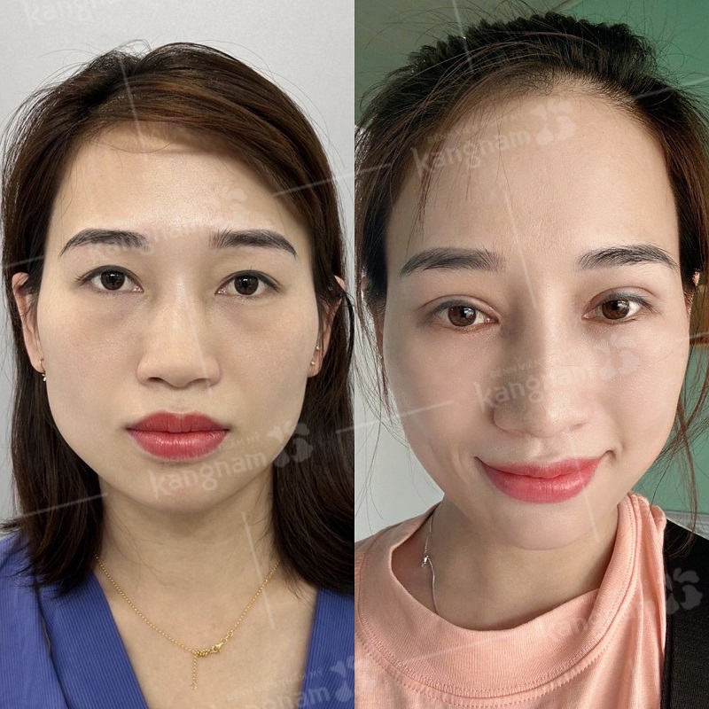 Khách hàng gặp tình trạng mí nhỏ, mí ẩn, mí lót