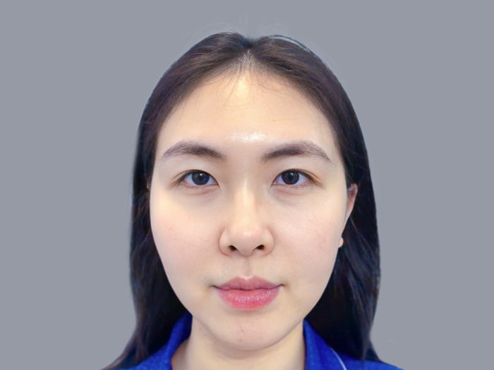 Mắt sụp mí, mí lót nên cân nhắc cắt mí