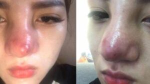 7 dấu hiệu nâng mũi bị viêm cần nhận biết sớm và xử lý kịp thời