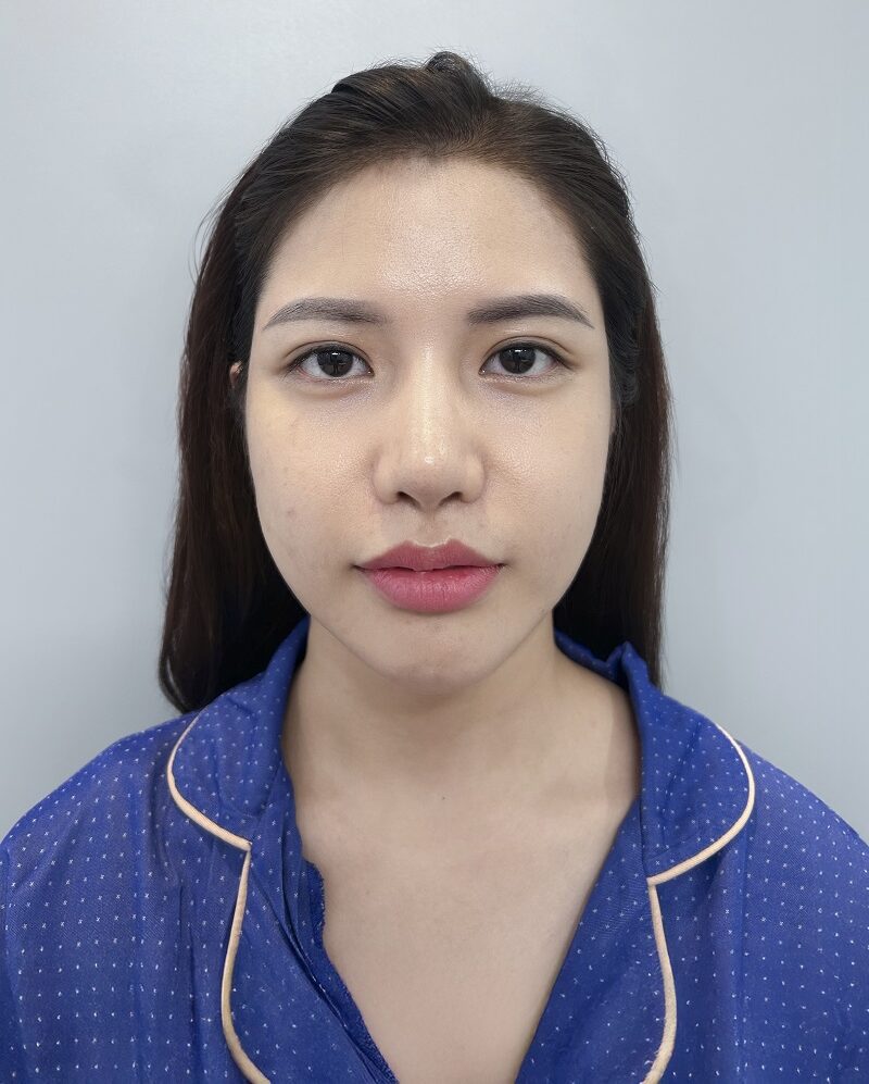 Nếp mí của Thảo không được đều