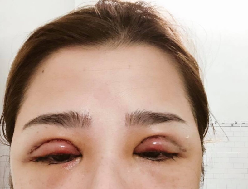 Mí mắt sưng tấy kéo dài bất thường