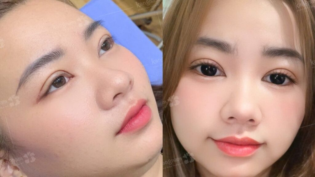 Cắt mí mắt bao lâu thì hết sưng? Thời gian hồi phục và cách giảm sưng hiệu quả