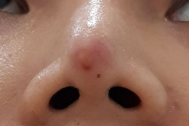 Dấu hiệu điển hình của tình trạng mũi không hợp sụn