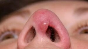 Dấu hiệu mũi không hợp sụn: Nhận biết sớm để tránh biến chứng nguy hiểm