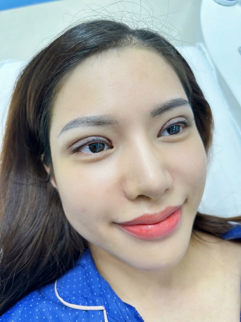 Mí mắt to tròn ngay sau khi cắt mí