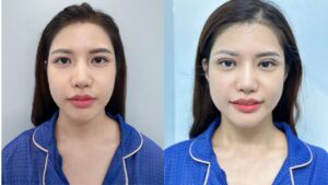 Cân chỉnh nếp mí hài hòa cho hot girl Thanh Thảo tại Kangnam Hà Nội