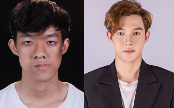 Minh Hoàng thay đổi ngoạn mục sau phẫu thuật thẩm mỹ