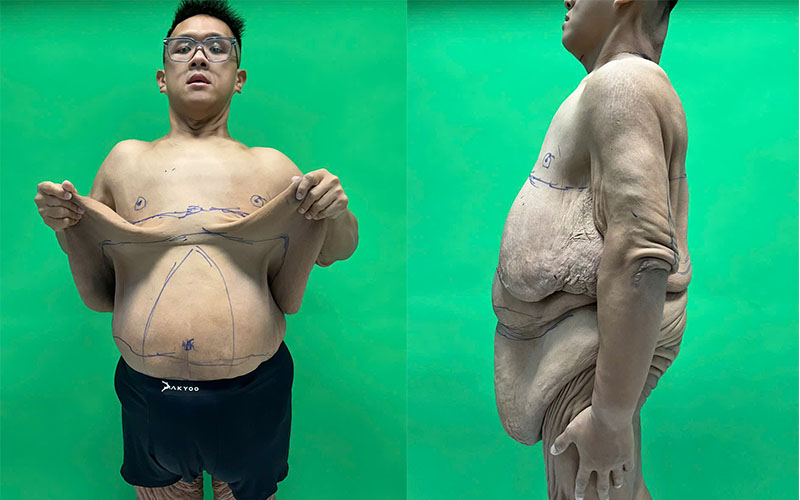 Tình trạng da thừa “khổng lồ” sau giảm cân của Trọng Nhân