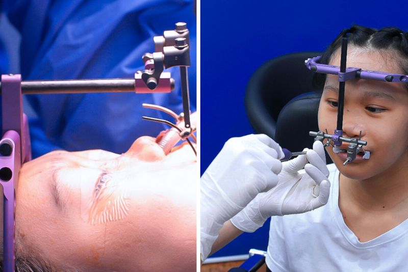 Xuân Mai đeo khí cụ R.E.D