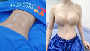 Công nghệ J-Plasma 2 trong 1: Giảm mỡ kết hợp săn chắc da toàn diện