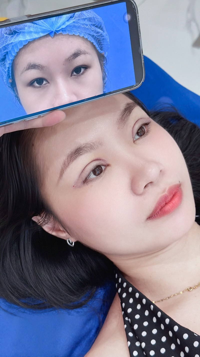 Mí mắt đã bớt sưng và cân đối hơn