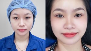 Gen Z Hà Phương giải cứu mắt mí sụp tại Kangnam Hà Nội