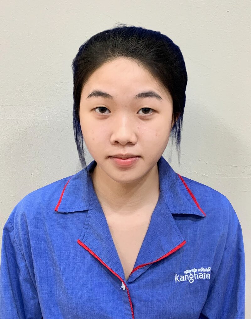 Thảo Anh gặp tình trạng mí lót, hai mí không đều