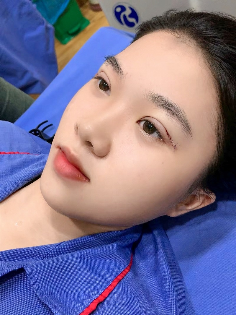 Sau khi vừa cắt mí, nếp mí không quá sưng