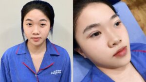 Lấy lại nếp mí cân đối sau 45 phút của Thảo Anh tại Kangnam