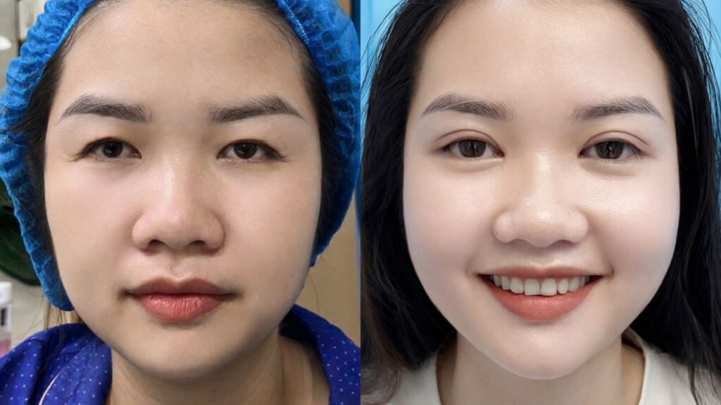 Hành trình “lột xác” đôi mắt của khách hàng Thúy Vân tại Kangnam Hà Nội