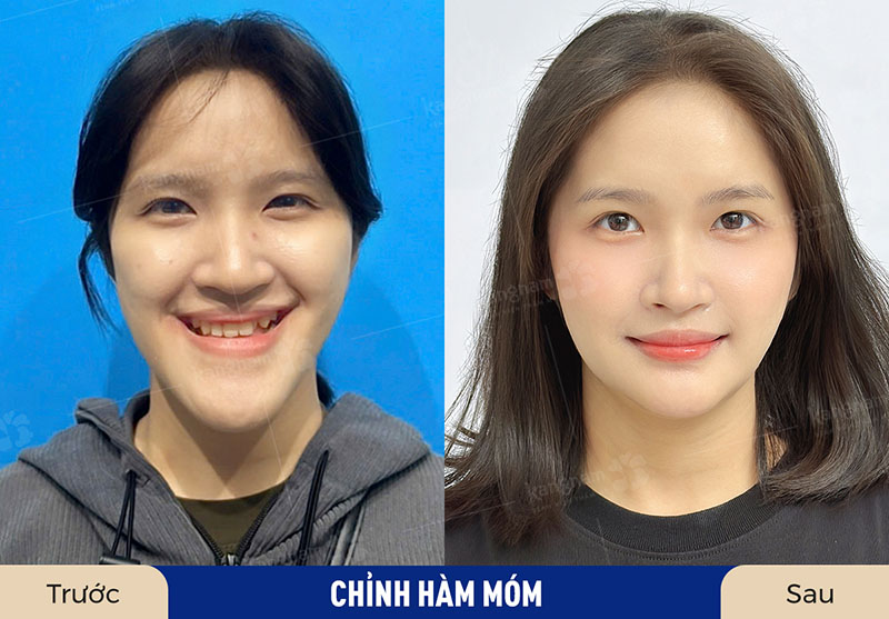 Kết quả phẫu thuật hàm phụ thuộc rất nhiều vào tay nghề bác sĩ