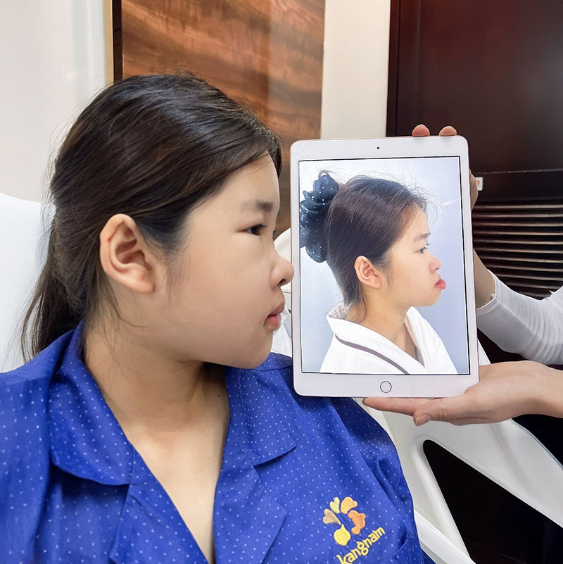 Một vài tuần đầu sau PT mặt có thể hơi sưng nề