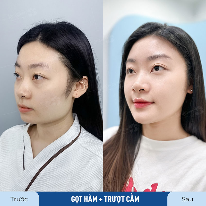 Phẫu thuật Hàm mặt mang đến sự thay đổi đáng kể